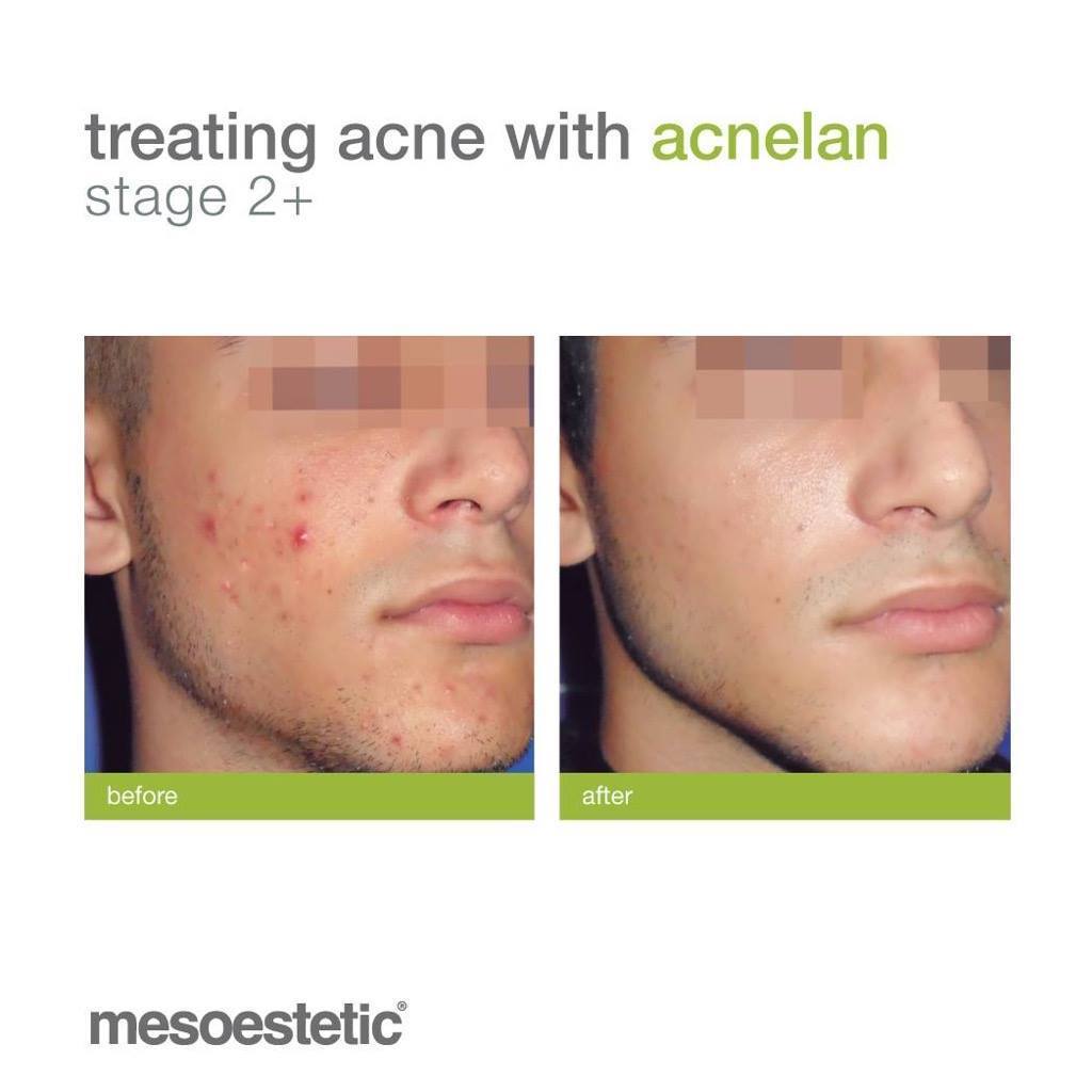 Acnelan Peeling Treatment for Acne prone skin